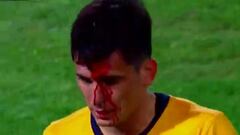 El duro golpe que dejó sangrando a Alfonso Parot