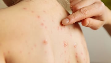 Alertan sobre los 5 focos vacacionales donde resurge un virus infantil medieval y uno de los países es España