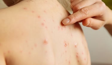 Estas son las precauciones que se recomiendan tomar por nuevo brote de sarampión en México