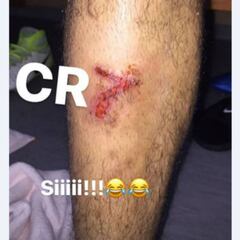 Fabinho recuerda a Cristiano al ver su escalofriante herida