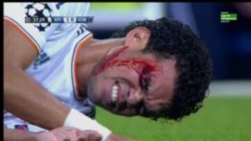 Pepe, sangrando.