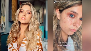 Laura Tobón sufre un desorden hormonal