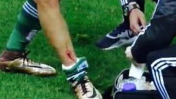 Imagen de televisión en la que se aprecia la herida de Dani Ceballos.