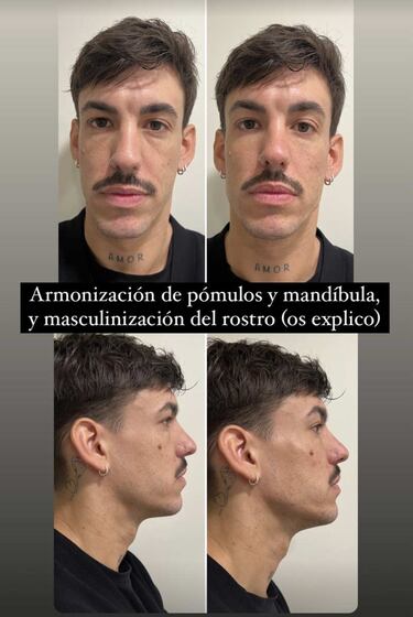 Luitingo muestra los resultados de su primer retoque estético: “Mi móvil no me reconoce”