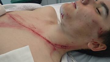 Andoni Azkarate muestra las heridas que sufri&oacute; tras chocar con un quitamiedos en los Campeonatos de Euskadi amateurs.