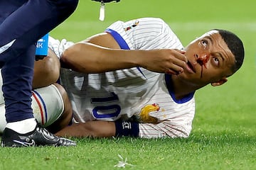 El primer partido de Kylian Mbappé en la Euro, tuvo una fatal consecuencia para el jugador, ya fichado por el Real Madrid, que sufrió una fractura de la nariz en el partido ante Austria, y tuvo que ser sustituido.