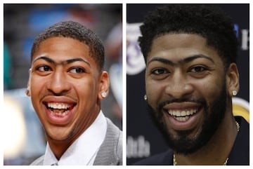 Anthony Davis luce con la camiseta de los Lakers en una imagen totalmente distinta gracias a la ortodoncia que le ha permitido rescatar algunas piezas dentales situadas demasiado dentro de su boca.