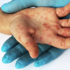 Viruela del mono en México: cuántos casos confirmados hay y qué medidas se van a tomar
