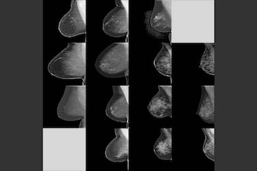 Cómo una IA es capaz de detectar el cáncer de mama tan bien como un radiólogo