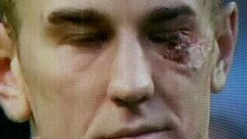 Así le dejó el ojo Jerome a Hart tras un brutal encontronazo