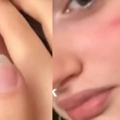 Preocupación en Italia por la ‘cicatriz francesa’, la última moda de TikTok