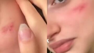Preocupaci¨®n en Italia por la ¡®cicatriz francesa¡¯, la ¨²ltima moda de TikTok