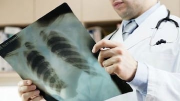 Descubren el fuerte daño a largo plazo en los pulmones de la COVID-19