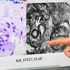 El coronavirus, presente en lesiones de la piel en pacientes con PCR negativo