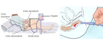 enema diagrama medicina enfermeria