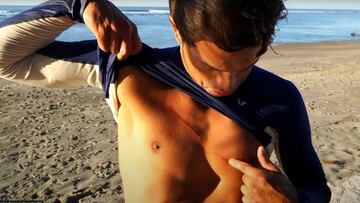 Kai Lenny enseñando un corte en el pecho