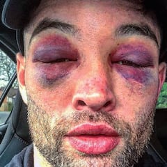 Las escalofriantes secuelas de Scott Fitzgerald tras un combate