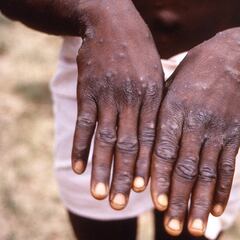 Viruela de mono en Estados Unidos: Síntomas, cómo se transmite y casos confirmados de monkeypox
