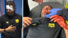 Suspendido el Marsella-Lyon tras ser herido Grosso al ser impactado por una lata de cerveza