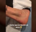 Pinilla mostró la hinchazón que posee en el tobillo: ¡Increíble!