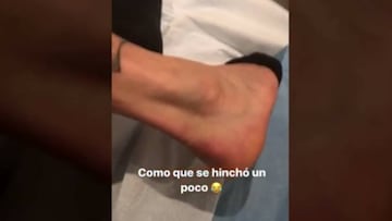Pinilla mostró la hinchazón que posee en el tobillo: ¡Increíble!