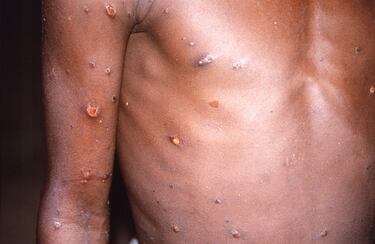 How many cases of monkeypox have been confirmed in the United States?