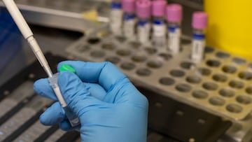 MADRID, SPAIN - JUNE 06: A medical laboratory technician inactivates suspected monkeypox samples to be PCR tested at the microbiology laboratory of La Paz Hospital on June 06, 2022 in Madrid, Spain. Europe is at the centre of the monkeypox virus outbreak, the World Health Organisation reported 780 confirmed cases with Britain, Spain and Portugal reporting the largest numbers of patients. (Photo by Pablo Blazquez Dominguez/Getty Images)