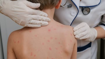 Vacunación infantil contra el sarampión se desploma en EE.UU.: ¿estamos al borde de una crisis sanitaria?