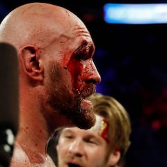 Fury se lleva 47 puntos de sutura de su combate con Wallin