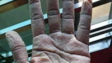Así queda la mano de un médico después de llevar guantes durante sus 10 horas de trabajo