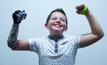 Crean un brazo biónico para un niño de nueve años