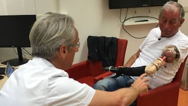 Pierde el brazo y le ponen uno prostético con Bluetooth