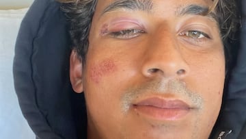 Samuel Pupo con la cara inflada