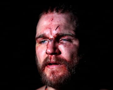 El BKB (Bare-knuckle boxing) es el deporte del boxeo sin el uso de guantes de boxeo u otro acolchado en las manos de los participantes.