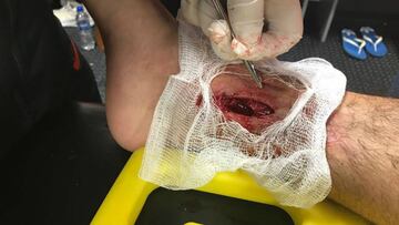 Club Pachuca publicó en redes sociales la fuerte herida del atacante mexicano, quien tuvo que ser trasladado de inmediato al hospital.