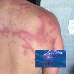 Un reportero explica cómo sufrió con la picadura de una carabela portuguesa