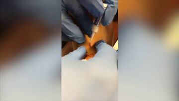 Filipe Luis posts video of doctors healing his gruesome injury