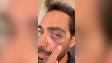 El mensaje de Alberto Contador tras su aparatosa caída en China: puntos en pómulo, ceja y labio
