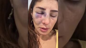 Deportista mexicana sufre golpiza por su pareja que es luchador de MMA