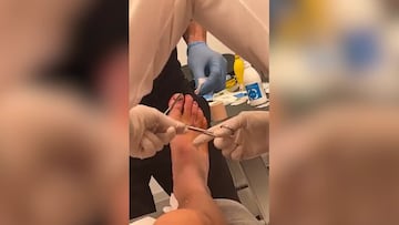 Así quedó el pie de Karim Benzemá tras el pisotón que sufrió y que le costó 5 puntadas