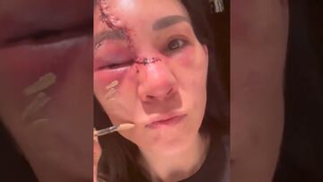 Vídeo: Así quedó el rostro recuperado de Irene Aldana tras el UFC 306