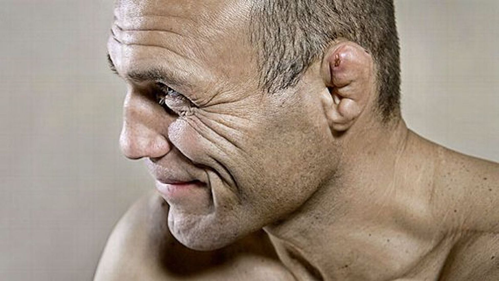Do boxers get cauliflower ear? What is cauliflower ear and does it go away?  - AS USA